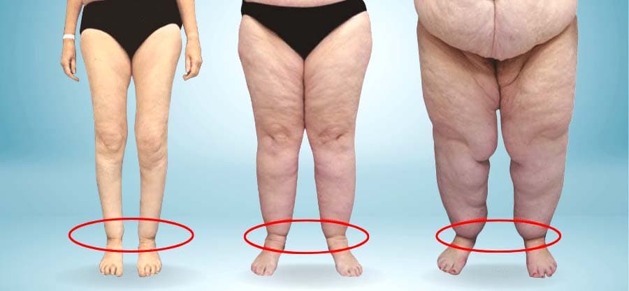 Lipödem erkennen: Unterschiede zwischen Lipödem und Lymphödem