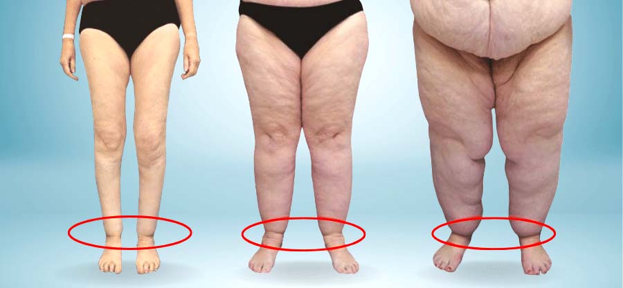 Lipödem erkennen: Unterschiede zwischen Lipödem und Lymphödem