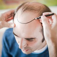 Achieving Hair Restoration Goals with Haartransplantation Türkei Kosten