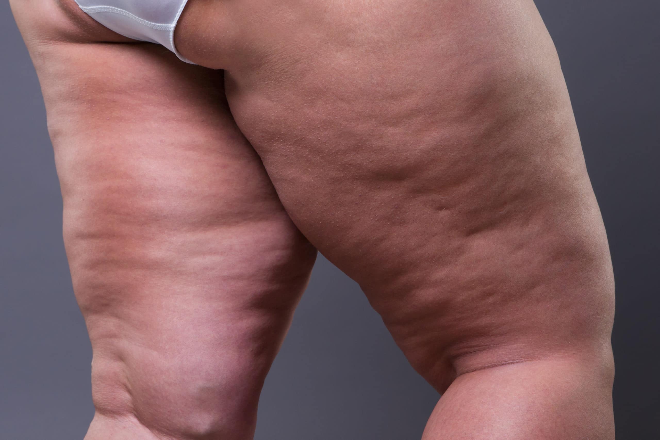 Lipödem-Operationen: Liposuktion als Behandlungsoption